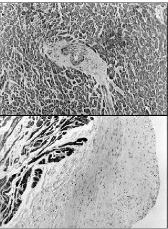 Fig. 2 – Perivascular fusiform myocardial fibrosis, without active inflammatory reaction (top) and extensive endocardial fibrosis (bottom)