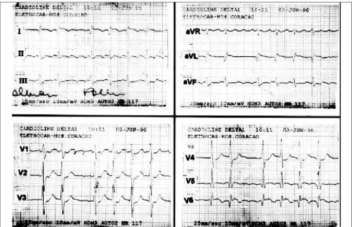 Fig. 1 – Initial electrocardiogram showing atrial fibrillation, necrosis and subepicardial current of injury in the lateral and upper lateral areas.