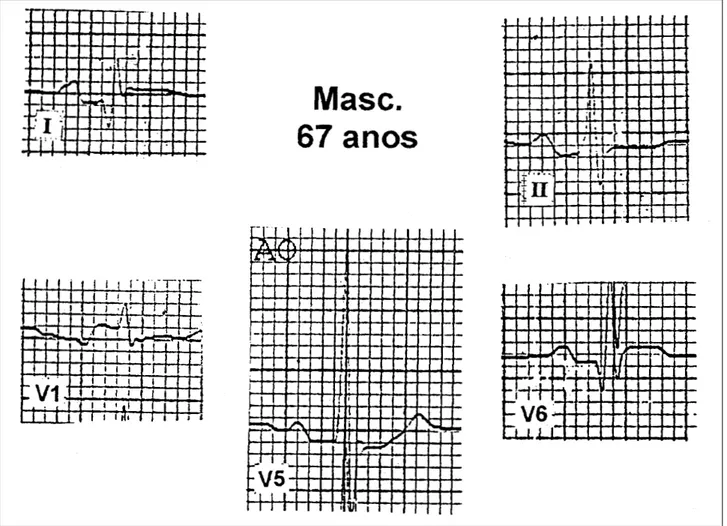 Fig. 3 - Amplification of leads showing in detail PR-segment abnormalities consistent with the diagnosis of atrial infarction in leads DI, DII, V 1 , V 5  and V 6 .