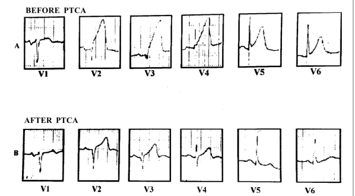 Fig 2 - A) Occlusion of the distal third of the anterior descending artery; B) Outcome after rescue angioplasty; C) The left ventricular function returned to normal.