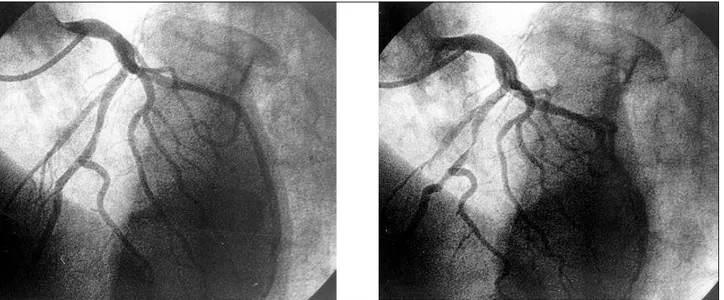 Fig 3 - A) Anterior descending artery (LAO) during diastole and B) during systole, showing the systolic compression of the vessel, which is consistent with myocardial bridge, in the occlusion site.