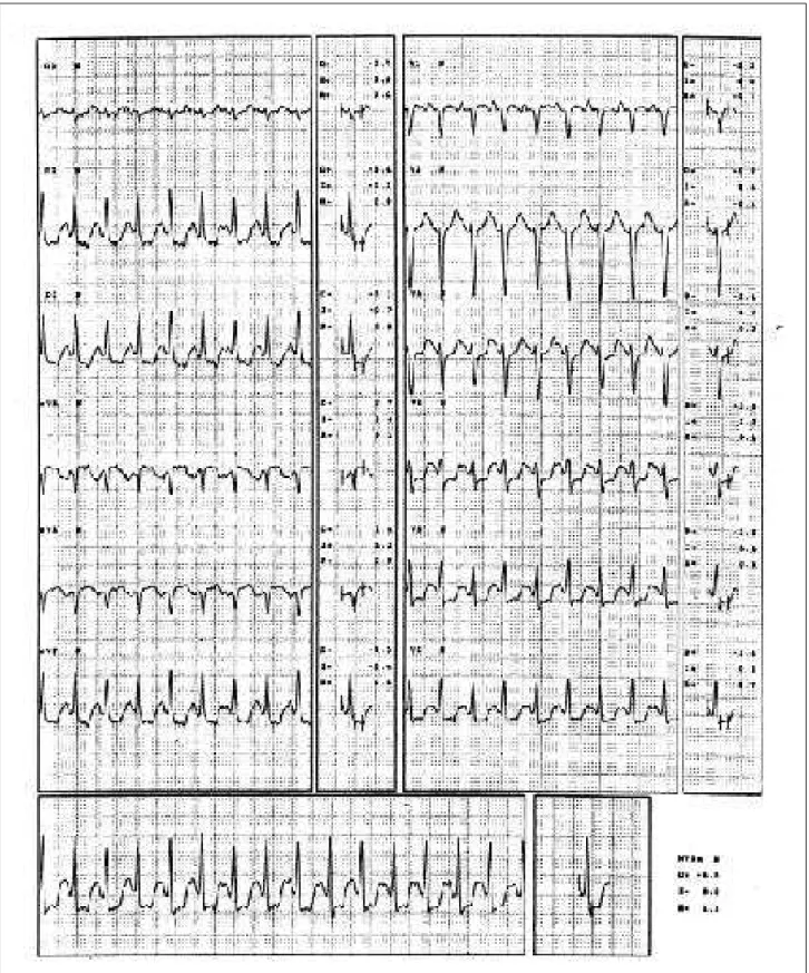 Fig. 2 - Electrocardiogram during exertion. Note the ischemic abnormalities in the classical leads and in lead V5.