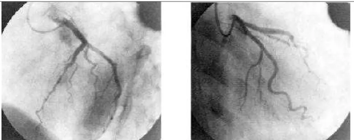 Fig. 3 - Coronary angiography. A) left coronary artery in RAO and LAO, respectively; B) Anterior descending and circumflex arteries without significant atheromatous lesions.