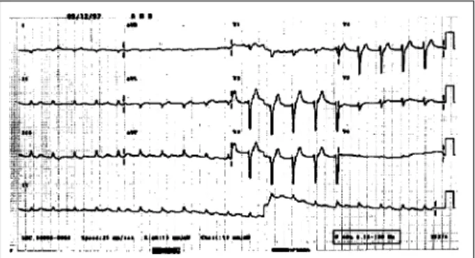 Fig. 1 – ECG - Atrial fibrillation; low-voltage QRS complex in the frontal plane;