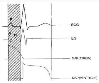 Fig. 2 - MAP catheter in right ventricle and sketch of the situation of the electrodes in relation to the myocardium.