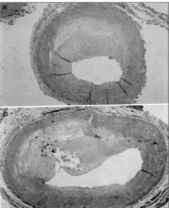 Figure 1 – Representative sections of stable (A) and unstable (B) plaque. A) See the significant thickness of the fibrous cap