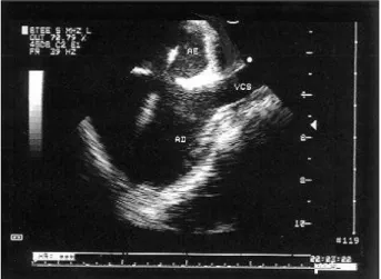 Fig. 2 - Transesophageal echocardiogram (long axis), showing the balloon positioned in the atrial septum during the measurement of the stretched diameter.