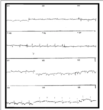 Fig. 1 – Electrocardiogram performed during the patient’s first admission. NOTE: Q wave in D3 and aVF, S wave in D1 and aVL, inverted T wave in D3 and V1-V4, and low-voltage QRS complexes.
