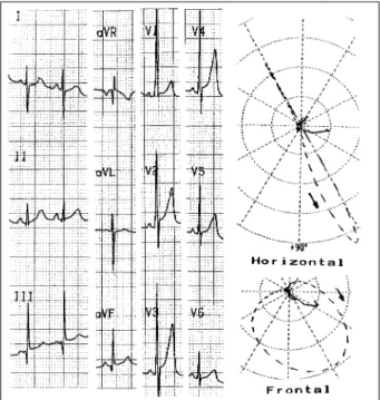 Fig. 1 - Electro and vectorcardiogram revealing right ventricular hypertrophy with the presence of left potentials