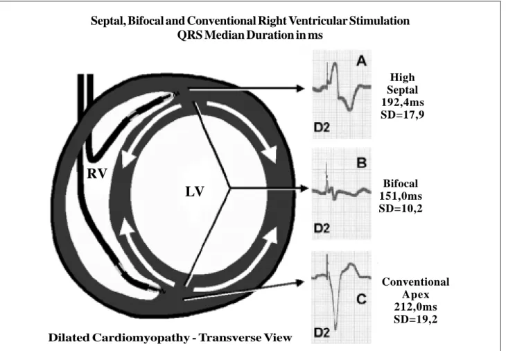 Fig. 2 - Scheme of the 3 stimulation modes used and tested in this study model with the stimulated QRS, the mean of durations and the standard deviation in the studied group A, B and C