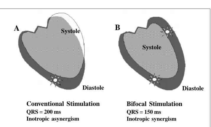 Fig. 3 - Scheme of the contraction damage caused by the lack of inotropic synchronism due to very slow myocardial conduction