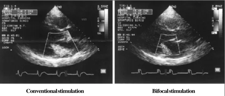 Fig. 4 - Impact of the right ventricular bifocal stimulation in the QRS narrowing. In this example the QRS from 240 ms in the conventional pacing narrowed to 150 ms in the bifocal stimulation
