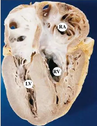 Fig. 2 - Longitudinal section of the heart, showing the 4 chambers. Marked concentric and symmetric hypertrophy of the left ventricle (LV) can be seen