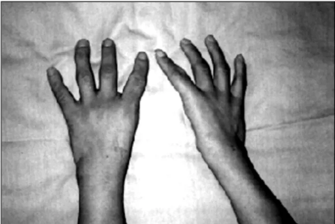 Fig. 1- Note the absence of thumbs.