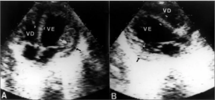Fig. 2 – Echocardiogram in the apical four chamber (A) and long axix (B) views, showing left ventricular hypertrophy