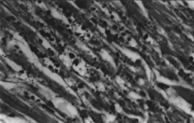 Fig. 3 - Aspecto histopatológico de um corte do fragmento de músculo esquelético da paciente corado pelo PAS (reativo de Schiff), que confere ao glicogênio uma cor  ver-melho magenta ou carmim