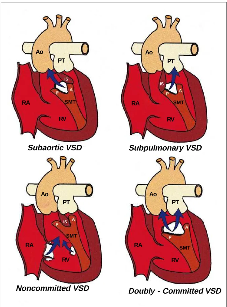 Fig. 1 – Illustration of the position of the ventricular septal defect (VSD) in hearts with double outlet right ventricle (DORV)