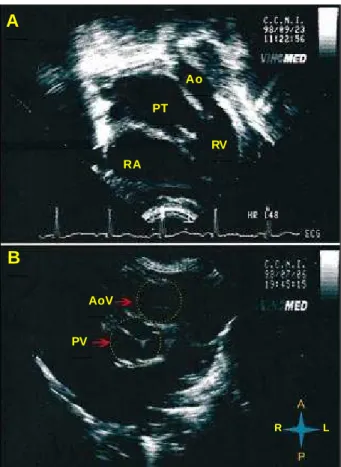 Fig. 3- A) Longitudinal parasternal section of the echocardiogram showing subpulmonary ventricular septal defect (VSD); B) the same section examined by Doppler with color flow mapping shows laminar flow in the interior of the pulmonary trunk (PT), consiste