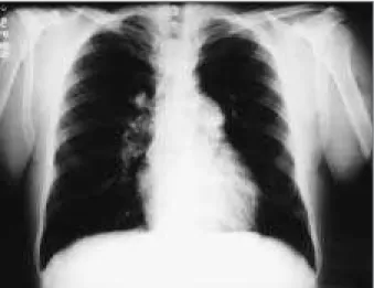Fig. 1- Chest x-ray - Note bulging of the pulmonary artery arch and increased size of right and left branches