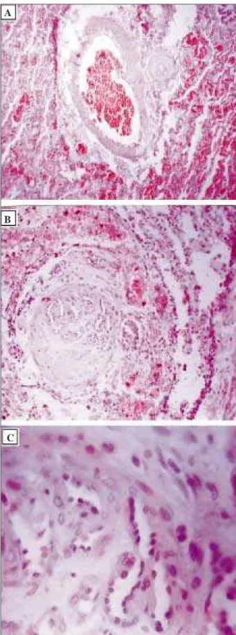 Fig. 3 – Pathological study - Microscopy: A) slight dilation of the pulmonary artery and thickening of the adjacent arteriolar wall, with hemorrhagic alveolar foci around