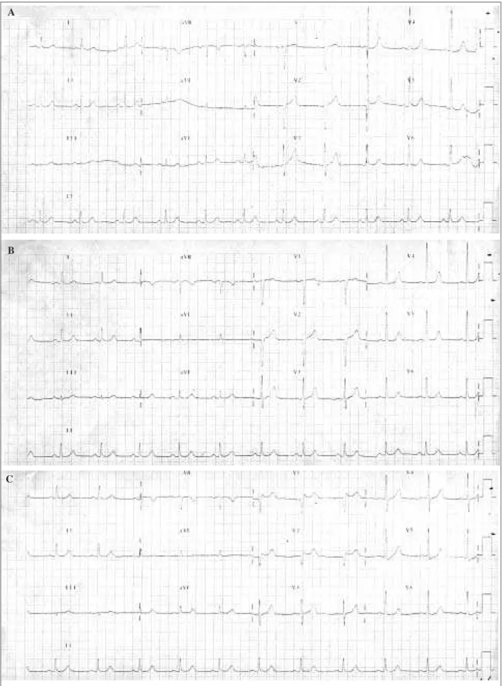 Fig. 1 - ECG tracings of a 68-year-old woman: ECG tracing with usual amount of electrode paste; ECG tracing with usual amount of electrode paste (control); ECG tracing with continuous electrode paste band.