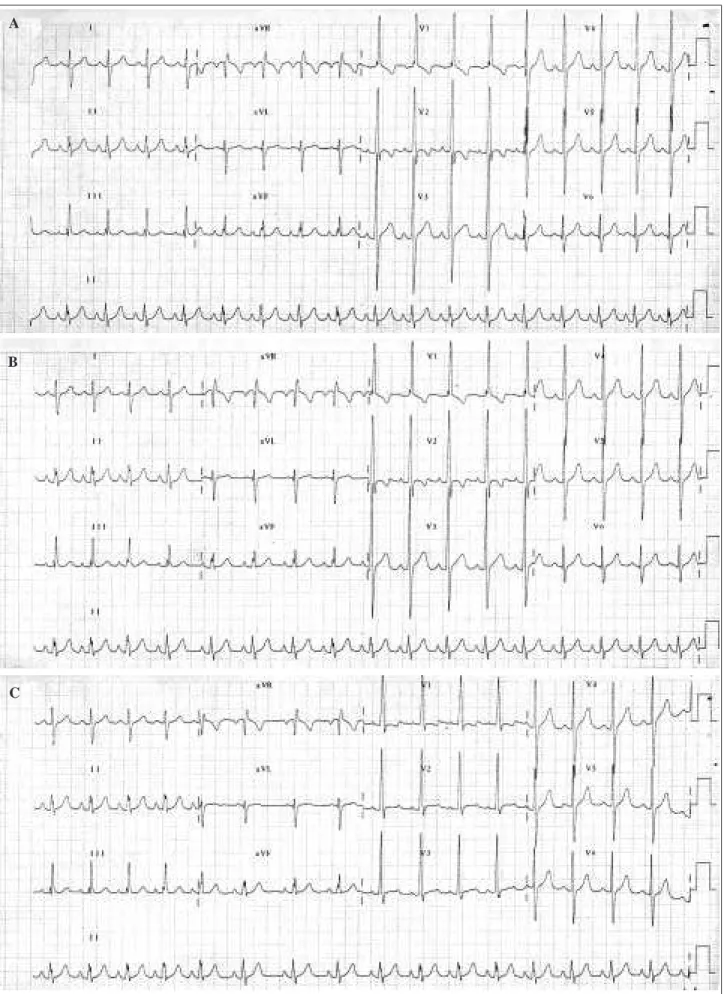 Fig. 2 - ECG tracings of a 9-year-old boy: ECG tracing with usual amount of electrode paste; ECG tracing with usual amount of electrode paste (control); ECG tracing with continuous electrode paste band.