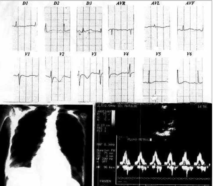 Fig. 1 -  Case 14 – Patient with mild ST-T segment abnormalities and mild increase in left chambers