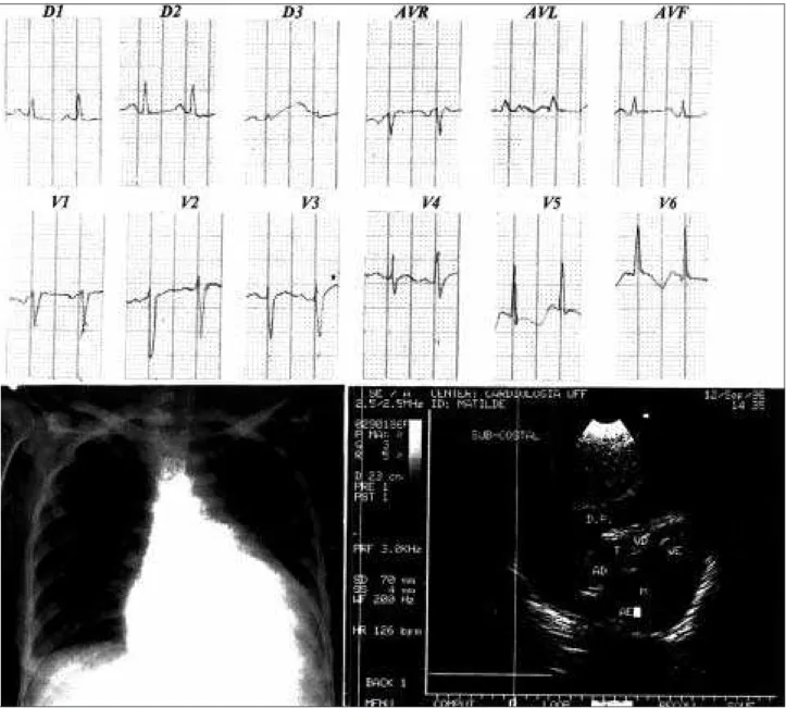 Fig.  2 -  Case 14 – Six months after (close to time of death): severe abnormalities of the ST-T segment, severe increase in the cardiac silhouette due to a large pericardial effusion confirmed by echocardiography.