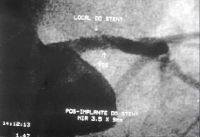 Fig. 1 – Left coronary angiography and ventriculography study. LCA dominant with  severe subocclusive stenosis in the middle portion.