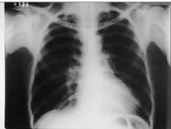 Fig. 2 - Enlarged heart and the ASD. Levoposition of the heart. AD- right atrium; AE- left atrium.