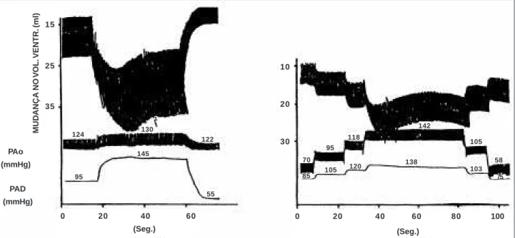 Fig. 3 - Left: Modifications in ventricular volumes of a dog’s heart, aortic pressures (PAo) and right atrial pressures (PAD) when elevating the venous chamber of heart-lung preparation (right atrial pressures - PAD of 95 to 145, and afterwards reduced to 