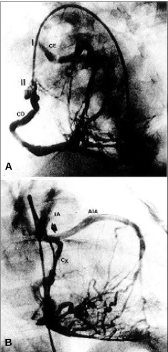 Fig. 1 – Coronary angiography in A (filling of the left coronary artery (LC) by collaterals from the right coronary artery (RC), in left anterior oblique view) and in B (LC in right anterior oblique view), showing the characteristic images of LC origin fro