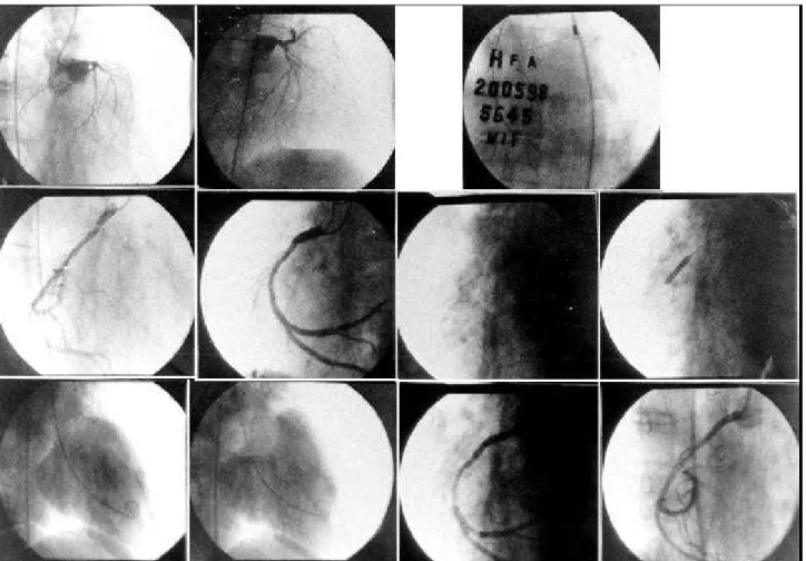 Fig. 1 – A patient with severe diffuse atherosclerosis of the left coronary artery. Severe LV dysfunction