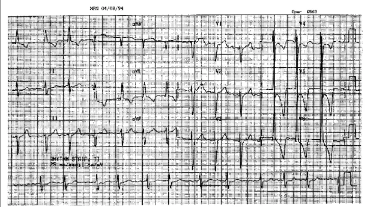Fig. 1 - Electrocardiogram. Atrial fibrillation, left ventricular hypertrophy and ventricular repolarization abnormalities.