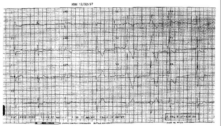 Table III – Prolonged electrocardiogram (Holter system)
