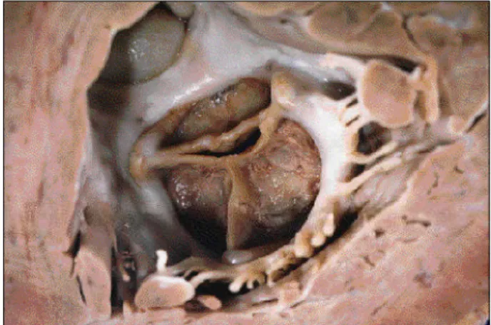 Fig. 5 – Histological section of mitral prosthesis leaflets, showing infectious endocarditis with multiple Gram-positive cocci