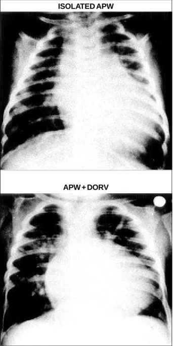 Fig. 2 - Chest X-rays comparing cardiac silhouette in isolated aortopulmonary window (group A) and in the presence of associated defects (group B – double outlet right ventricle).