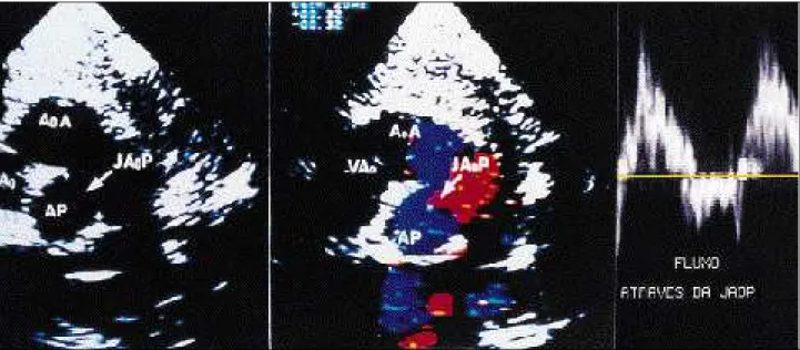 Fig. 3 - Suprasternal plane showing the longitudinal axis of the aortic arch: A) Two-dimensional image shows the proximal communication between the ascending aorta and the pulmonary trunk (type I APW); B) bidirectional flow by color Doppler: red flow from 