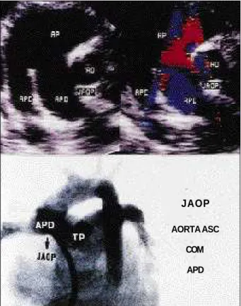 Fig. 4 - High parasternal short axis plane: A) two-dimensional image: the distal communication between the ascending aorta and the right pulmonary artery and the normal continuity between the pulmonary trunk and the left pulmonary artery are visualized