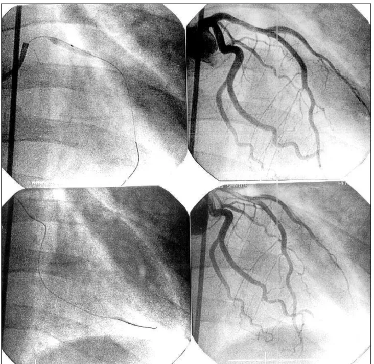Fig. 2 – A) Insufflated balloon in the proximal portion of the AD; B) contrast medium injection showing a successful procedure in the proximal third of the AD and occlusion of the distal third of the M2; C) Insufflated balloon in the distal portion of M2; 