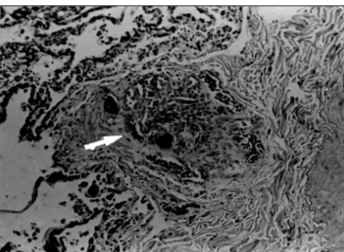 Fig. 5 – Microphotograph of the lung. Plexiform vascular lesion characterizing Heath-Edwards grade IV pulmonary hypertension (arrow) (hematoxylin and eosin, 10X).