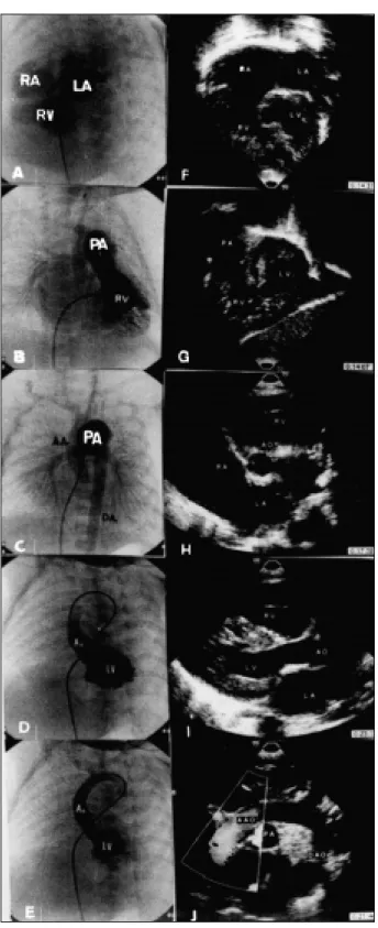 Fig. 2 - Macroscopic view of the heart. A, Right lateral view of the great vessels.  The large ascending aorta is apparent (Ao), which was anastomosed to the pulmonary  arte-ry (PA)