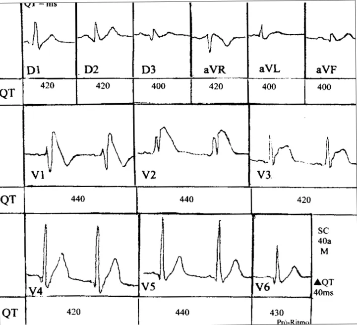 Fig. 1 – Electrocardiographic pattern of the patient. Significant alterations of the ST segment in the right precordial leads and an activation pattern of the right bundle-branch block type are notable.