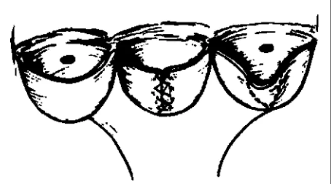 Fig. 5 – Triangular resection of prolapsed cusp with double continuous sutures.