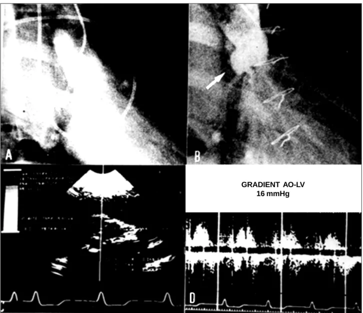 Fig. 9 – A and B: Aortography in diastole before and after the restoration of the posterior aortic cusp with bovine pericardium; C and D: postoperative echodopplercardiography.