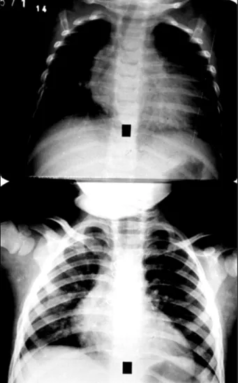 Fig. 2 - Electrocardiogram of case 1, showing preoperative signs of antero-lateral infarct (A) and improved ventricular repolarization of the anterior wall 11 months following surgery (B).