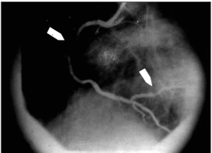 Fig. 3 - Coronary angiography showing a 95% segmentary lesion with irregular margins in the proximal portion of the anterior descending artery.