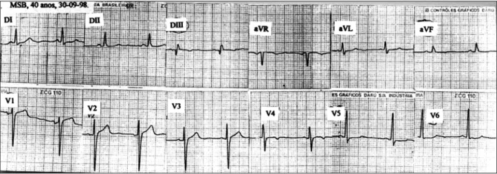 Fig. 5 – Electrocardiogram showing sinus rhythm, an inferior probably inactive area, and unspecific alterations of ventricular repolarization.
