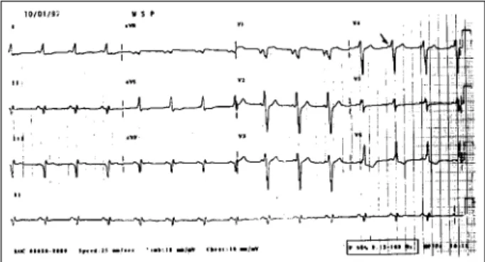Fig. 1 - Electrocardiogram – preexcitation syndrome, intermittent delta waves.