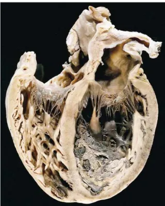 Fig. 2 – Section showing dilation of the 4 cardiac chambers and biventricular thrombosis.